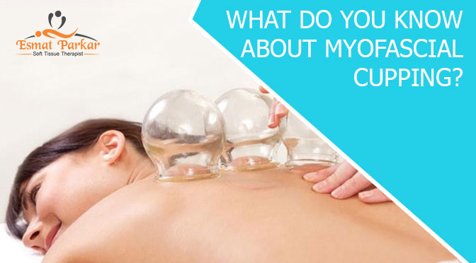 WHAT DO YOU KNOW ABOUT MYOFASCIAL CUPPING?
