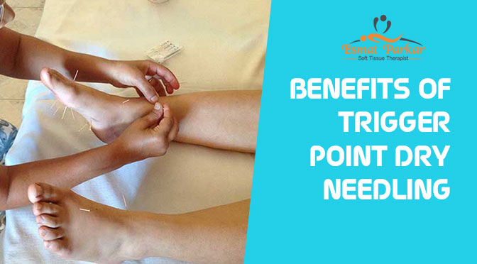 BENEFITS OF TRIGGER POINT DRY NEEDLING